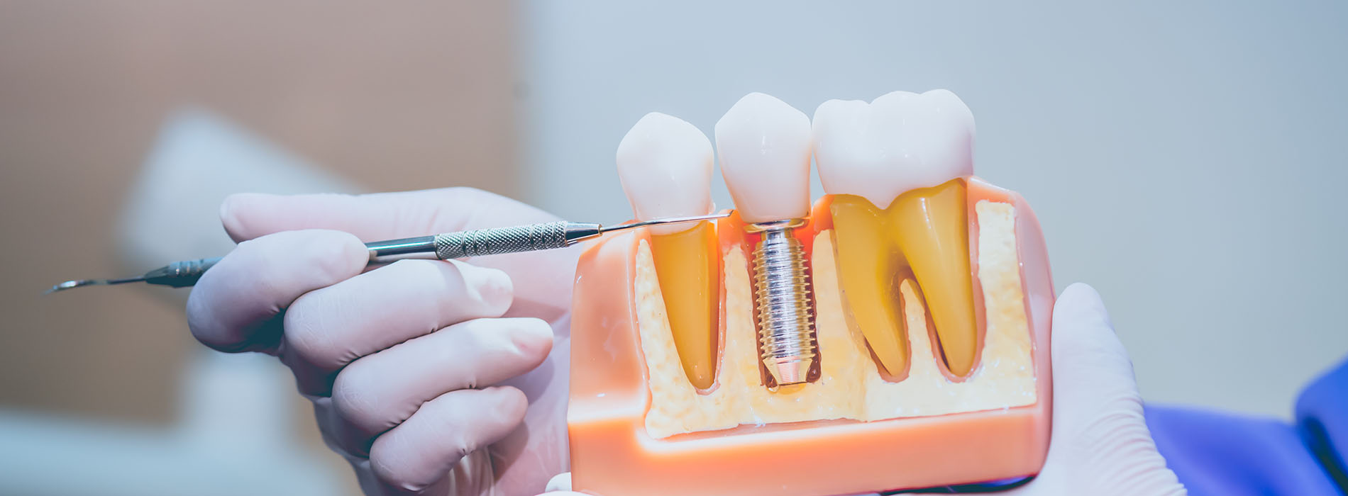 Dental Implant Restorations in Potomac MD